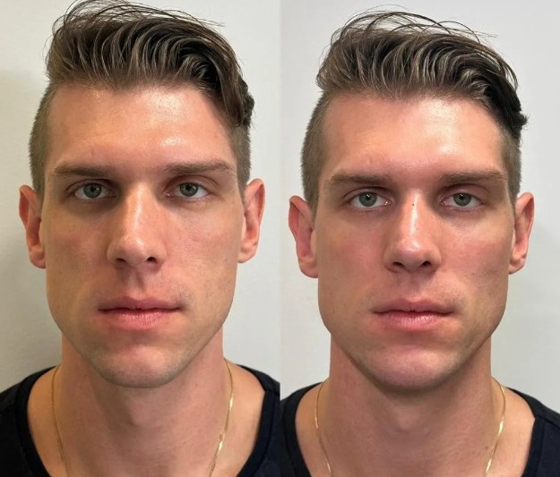 Ex-BBB Cristian faz harmonização facial com médico de Bruno Gaga; veja antes e depois