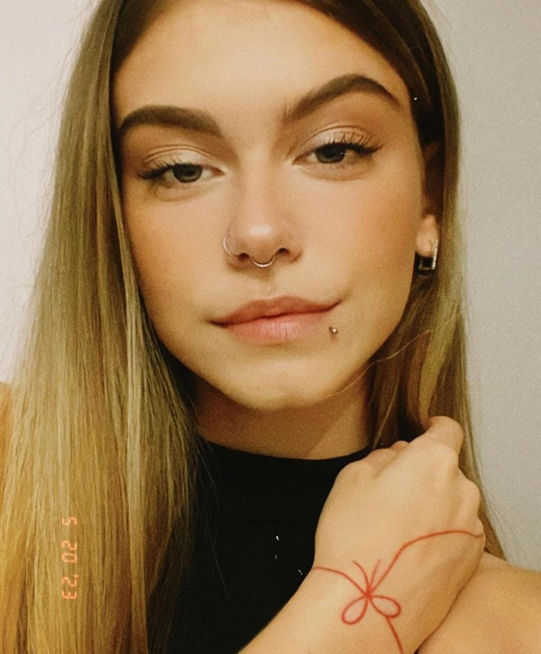 Universitária de 18 anos morre após contrair superbactéria por acne no rosto