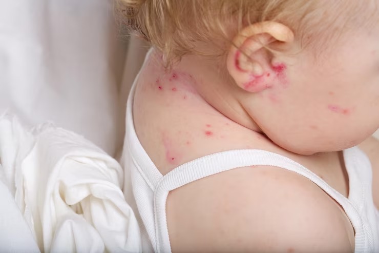 Pesquisa mostra que crianças alérgicas têm mais tendências para desenvolver outras alergias