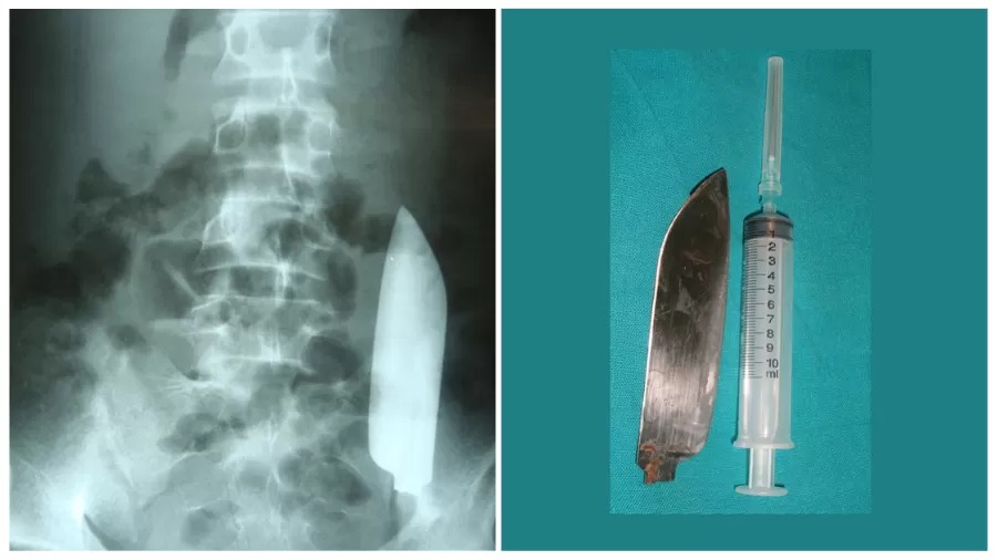 Jovem é esfaqueado em briga de bar e sobrevive ao ser deixado com faca dentro da barriga