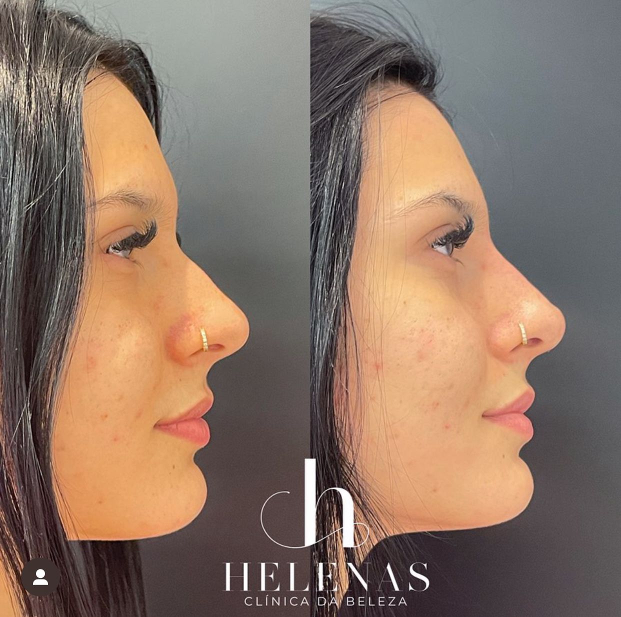 Ana Castela faz procedimento no nariz e mostra antes e depois 