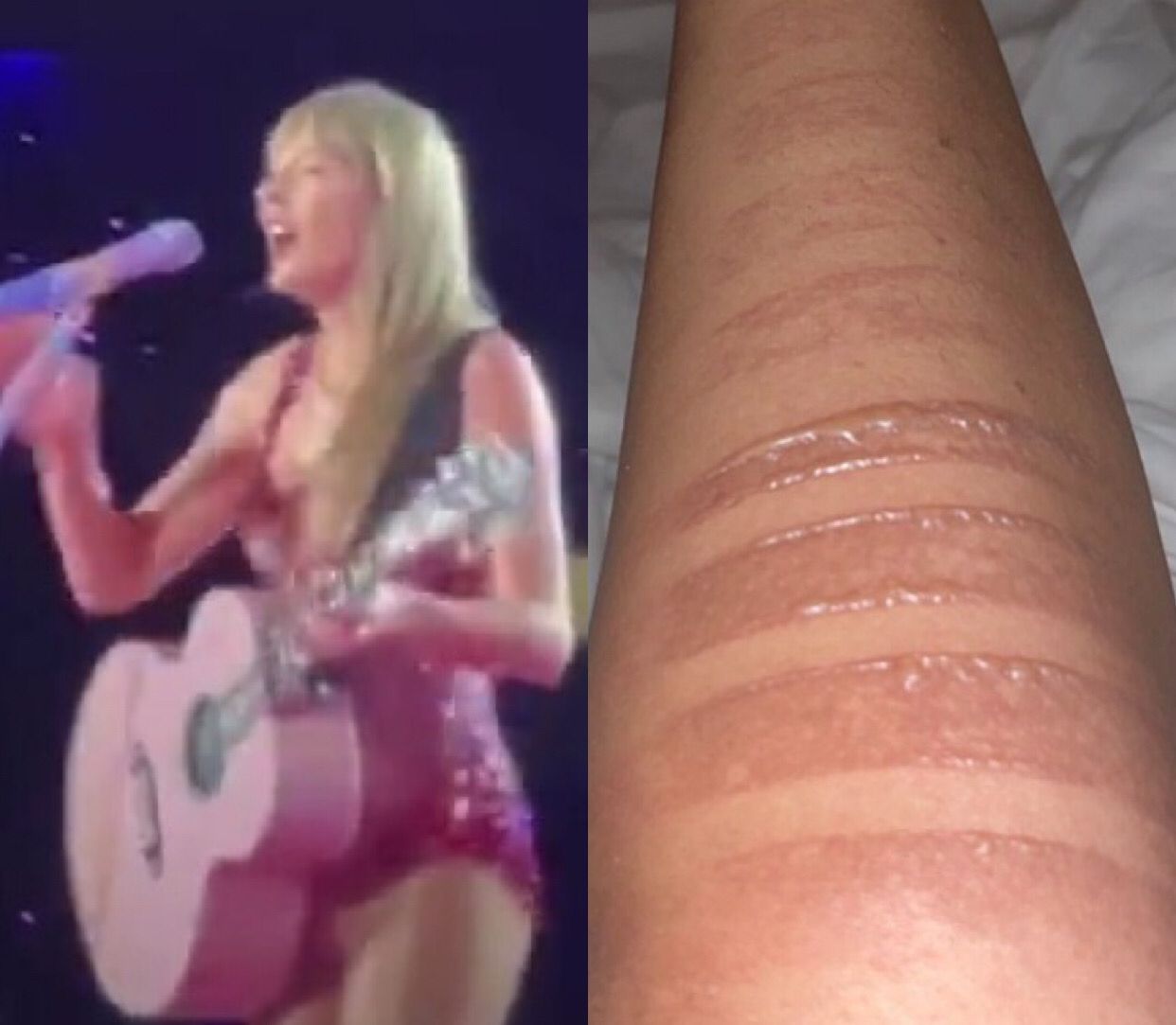 Fã de Taylor Swift mostra queimadura na perna após empurra-empurra no Engenhão