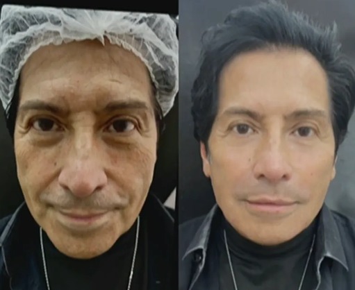 Mister M faz harmonização facial e mostra resultado