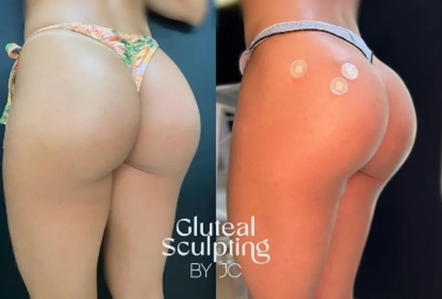 Antes de entrar no BBB24, Isabelle fez harmonização no bumbum; Veja antes e depois