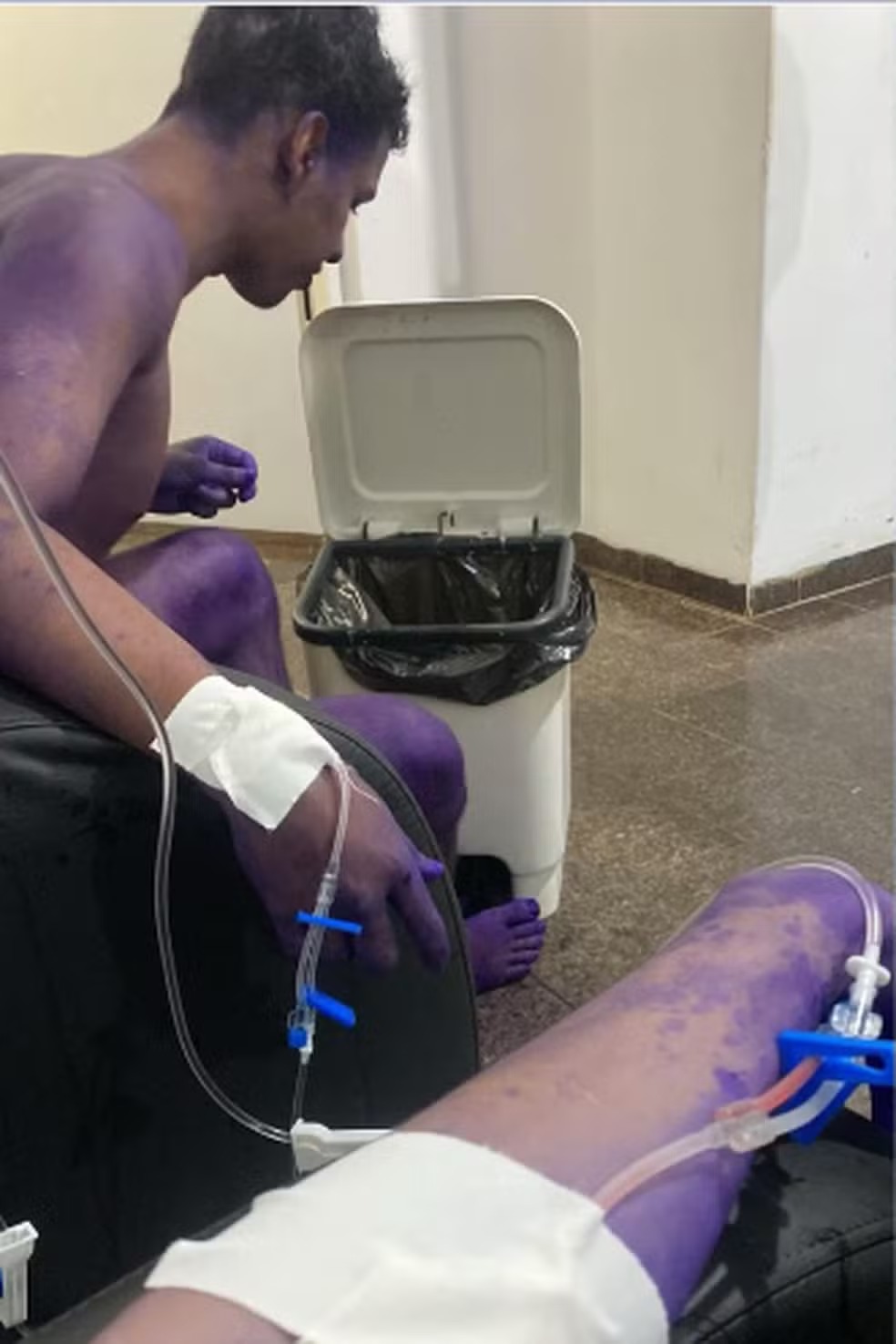 Trote universitário com produto tóxico deixa 4 calouros hospitalizados