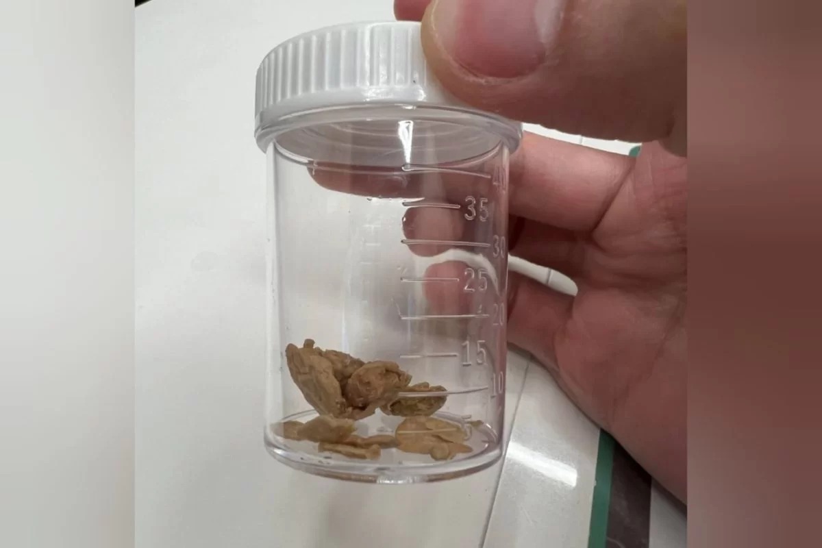 Homem fica com pedras de esmegma após passar 30 anos sem lavar o pênis