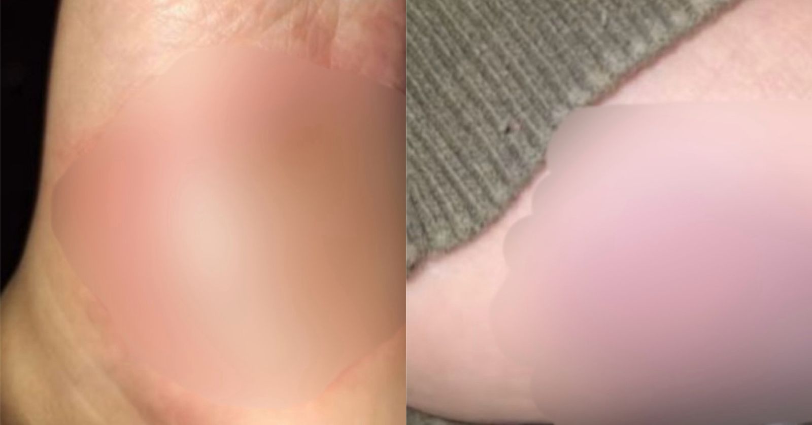 Fotos mostram como ficaram pés de bebê queimado com colher quente pela madrasta em Manaus