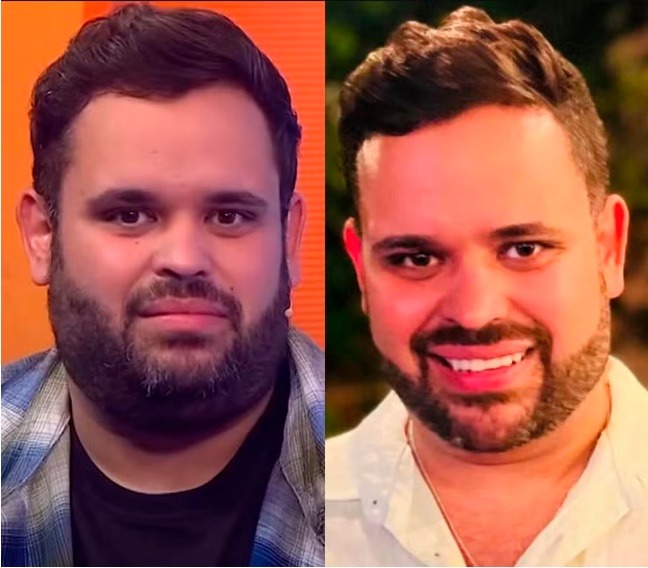 Michel, do BBB 24, passa por procedimento estético e mostra resultado