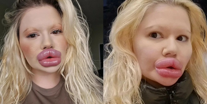 Influencer com os maiores lábios do mundo choca com aparência e ignora alerta de médicos