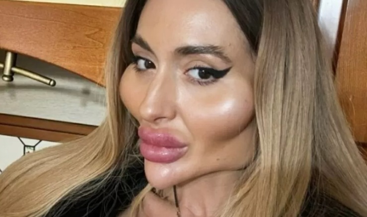 Mulher com as maiores bochechas do mundo faz novo procedimento no rosto