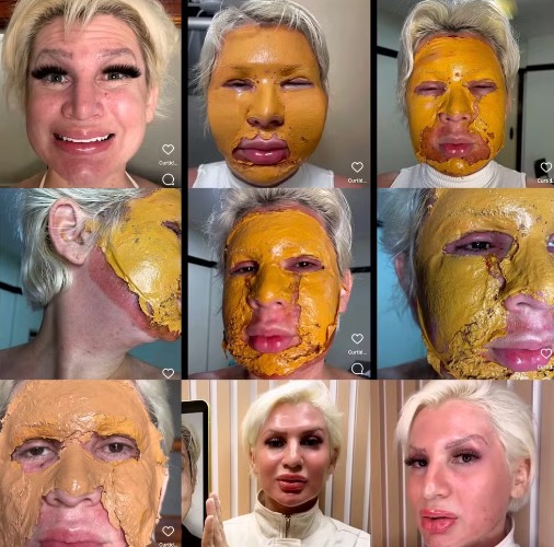 Romagaga fez peeling de fenol na mesma clínica envolvida em caso de morte