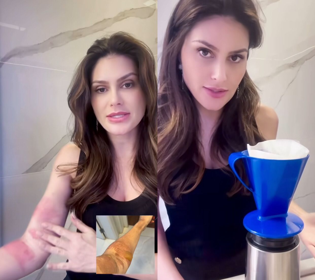 Ex-Miss Brasil Natália Guimarães sofre queimadura grave em acidente doméstico