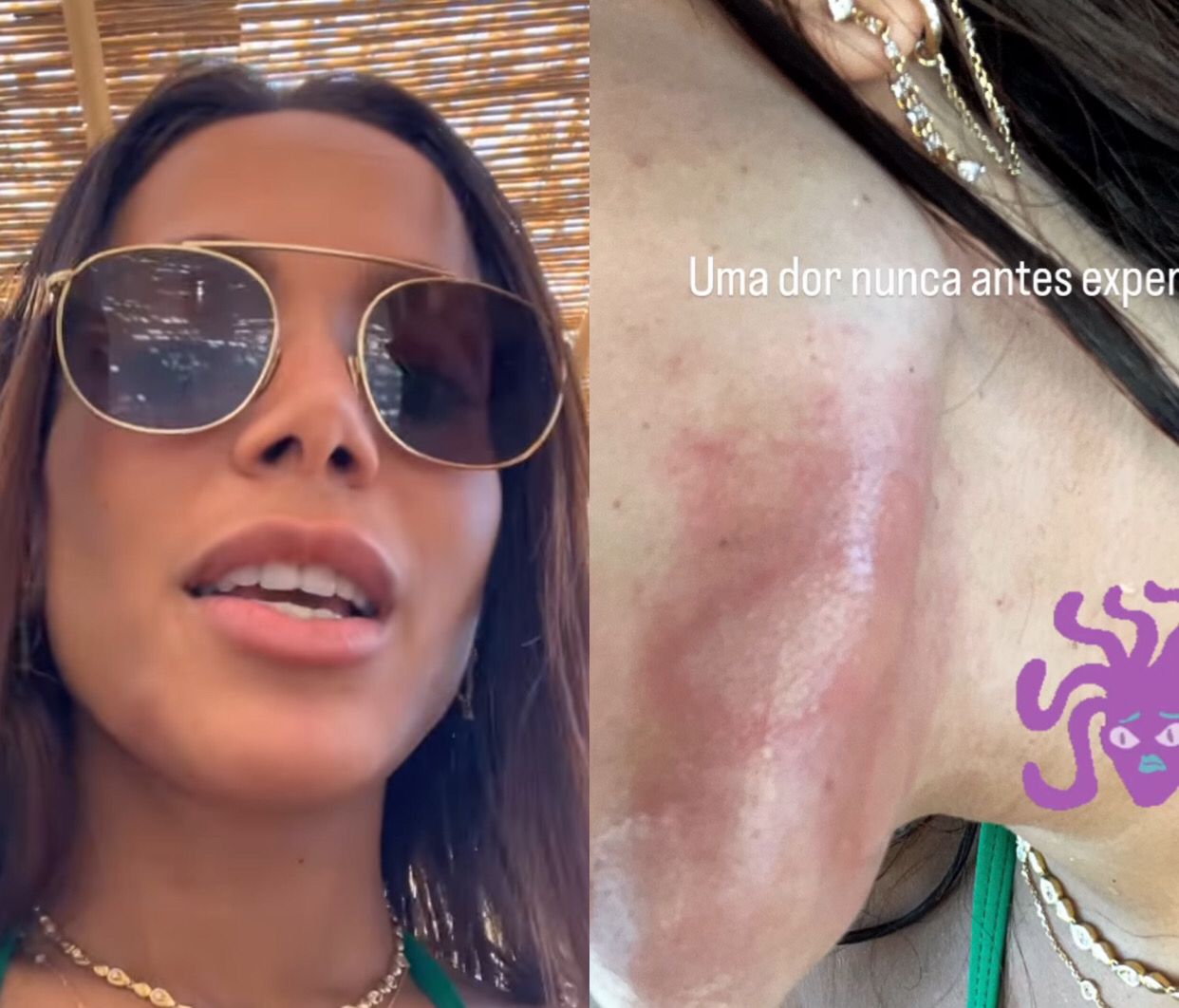 Anitta sofre queimadura de água-viva em Ibiza: 'dor que nunca senti na vida'