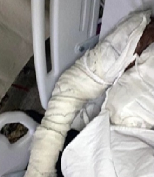 Adolescente tem corpo queimado com óleo quente em ataque motivado por ciúmes