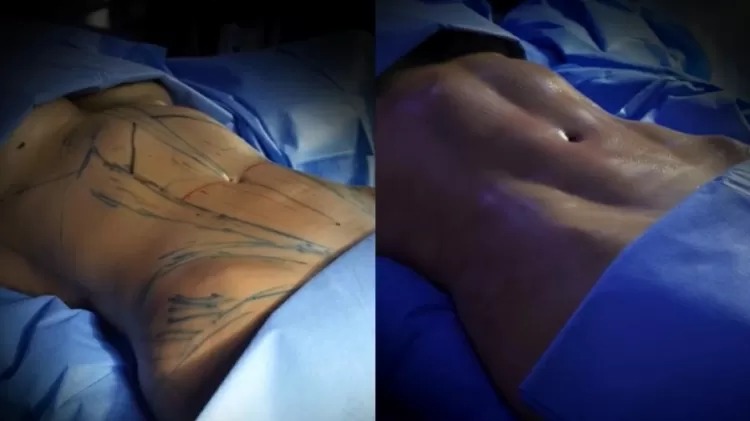 Lívia Andrade mostra antes e depois de lipo LAD; veja