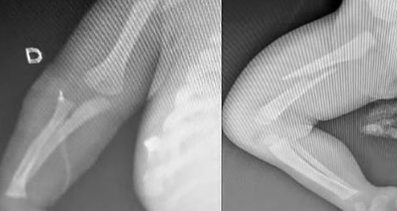 Bebê é internado com fraturas após ser espancado pelo pai por 'chorar demais'