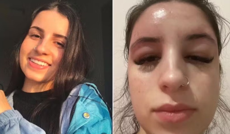 Jovem viraliza no TikTok após infecção grave causada por espremer espinhas