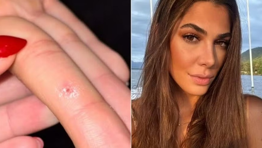 Mulher diz ter sido infectada com HPV após usar aparelho de academia