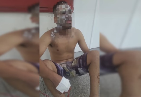 Mulher queima o rosto do companheiro com água fervente durante discussão