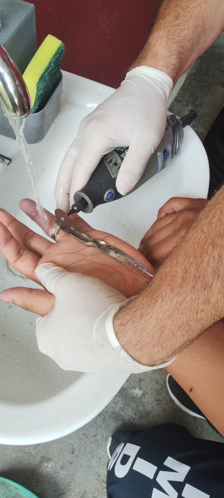 Mais de 400 pessoas são socorridas por ano em Manaus com anéis presos aos dedos