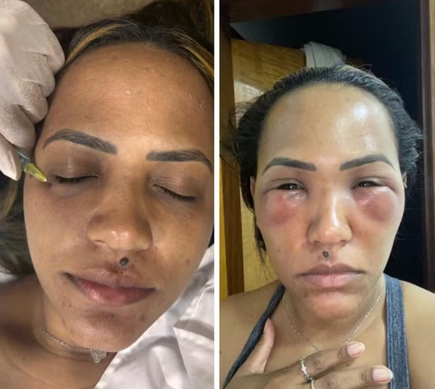 Mulher desenvolve infecção após procedimento estético na região dos olhos
