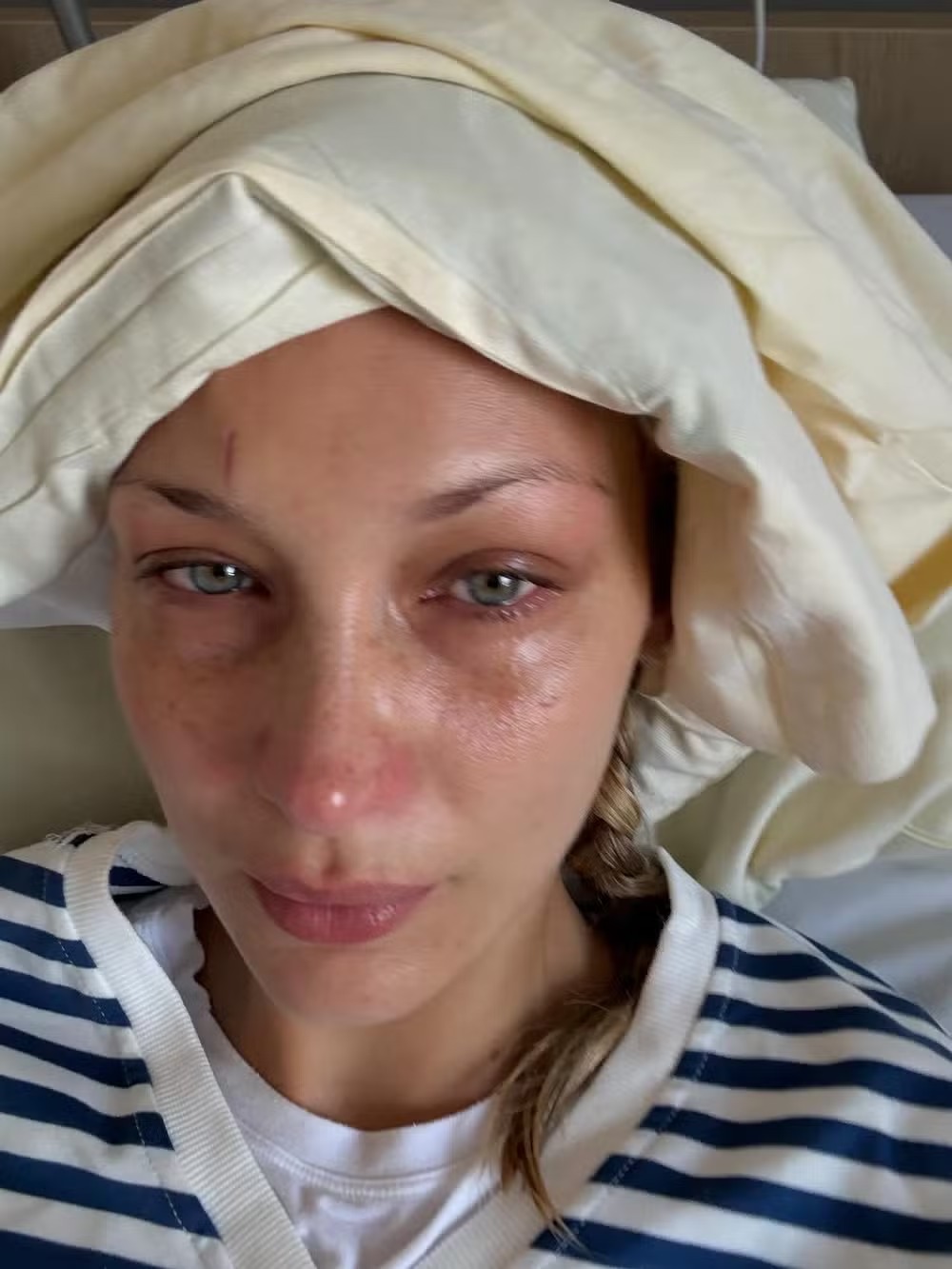 Bella Hadid é internada com doença de Lyme