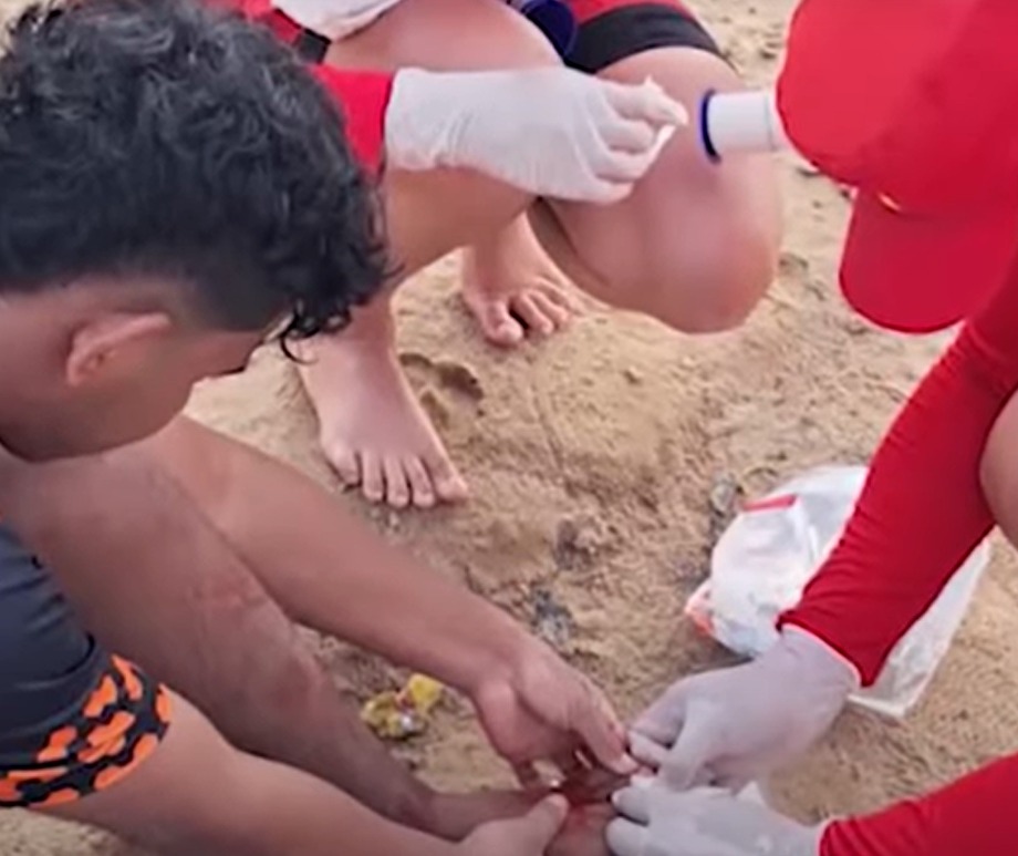 Seis banhistas ficam feridos em novo ataque de piranhas em balneário em Manacapuru 