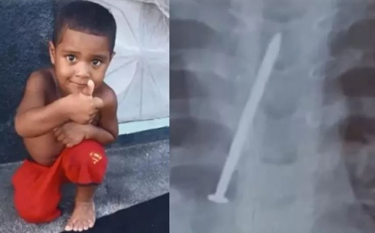 Criança morre após passar um ano com prego no pulmão