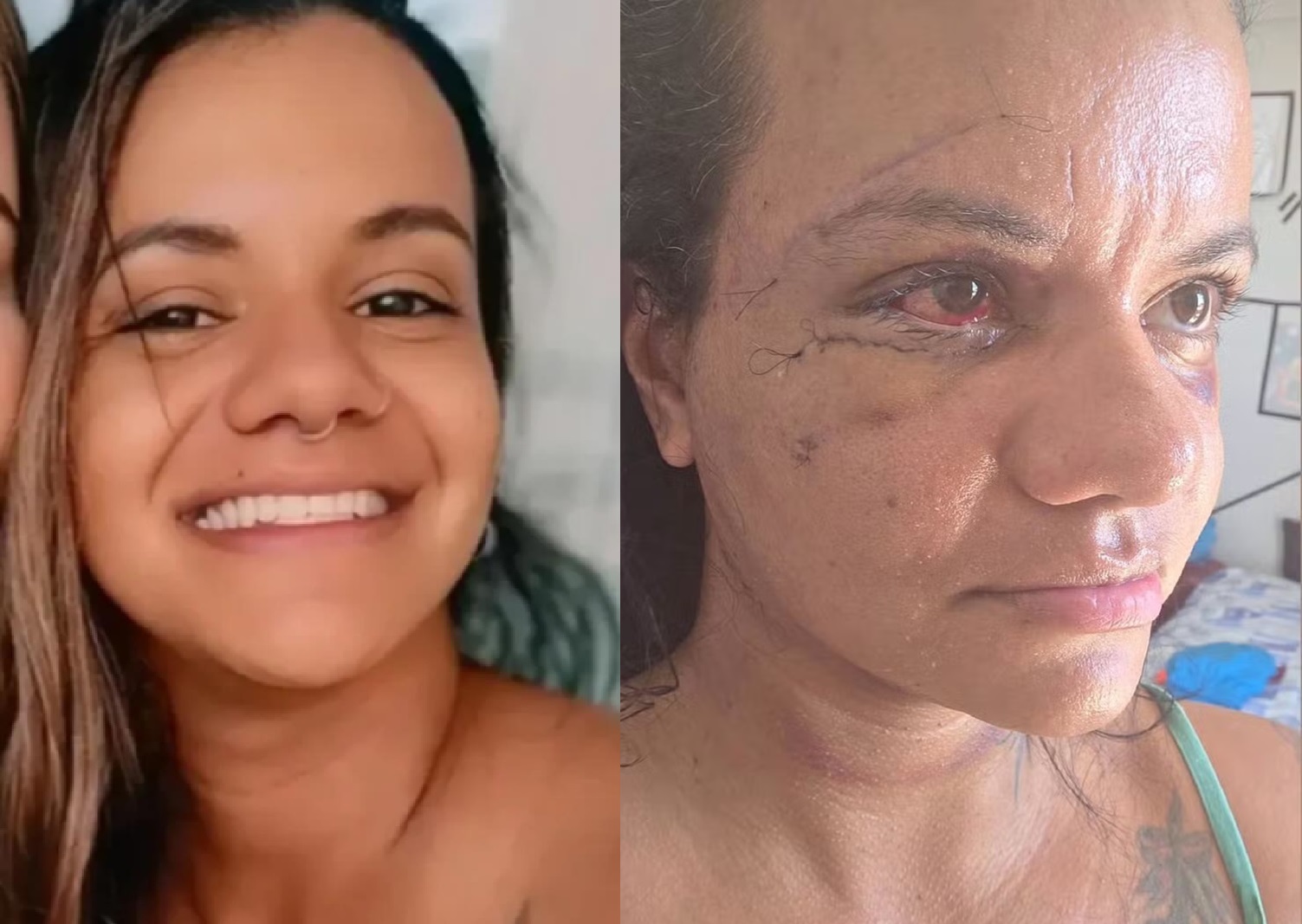 Mulher espancada em elevador mostra o rosto após cirurgia de reconstrução 