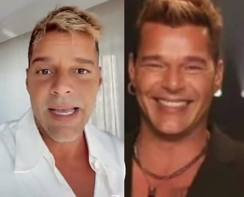 Ricky Martin mostra rosto desinchado após suspeita de harmonização facial: 'alergia'