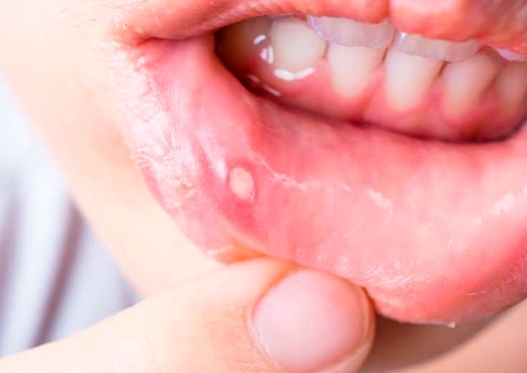 Aftas podem virar tumor? Especialistas explicam
