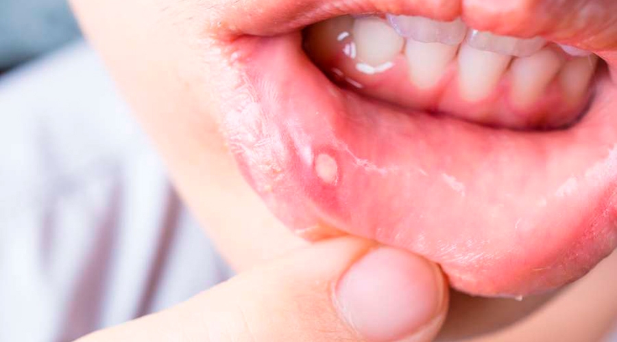 Aftas podem virar tumor? Especialistas explicam