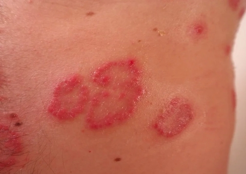 Dia Mundial da Psoríase: como a pandemia pode agravar o quadro