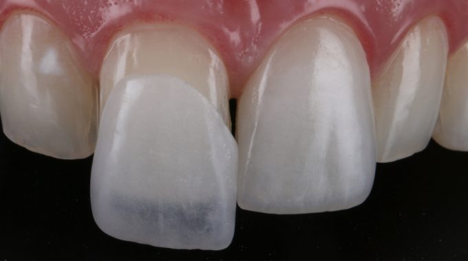 É seguro usar lentes de contato dental? Especialista explica 