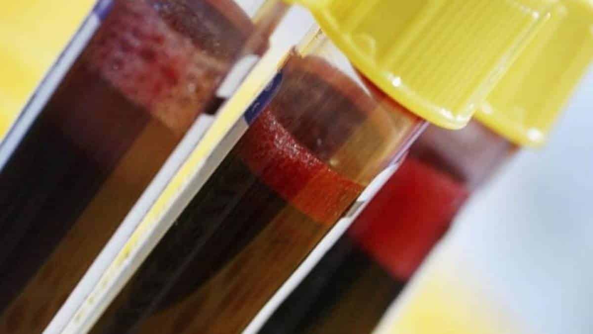 Cientistas descobrem que tipo sanguíneo é menos vulnerável ao coronavírus