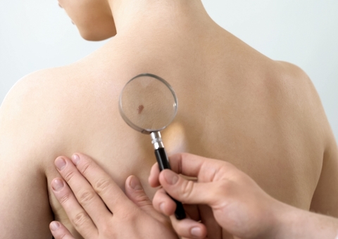 Câncer de pele é o tipo mais comum entre a população brasileira 