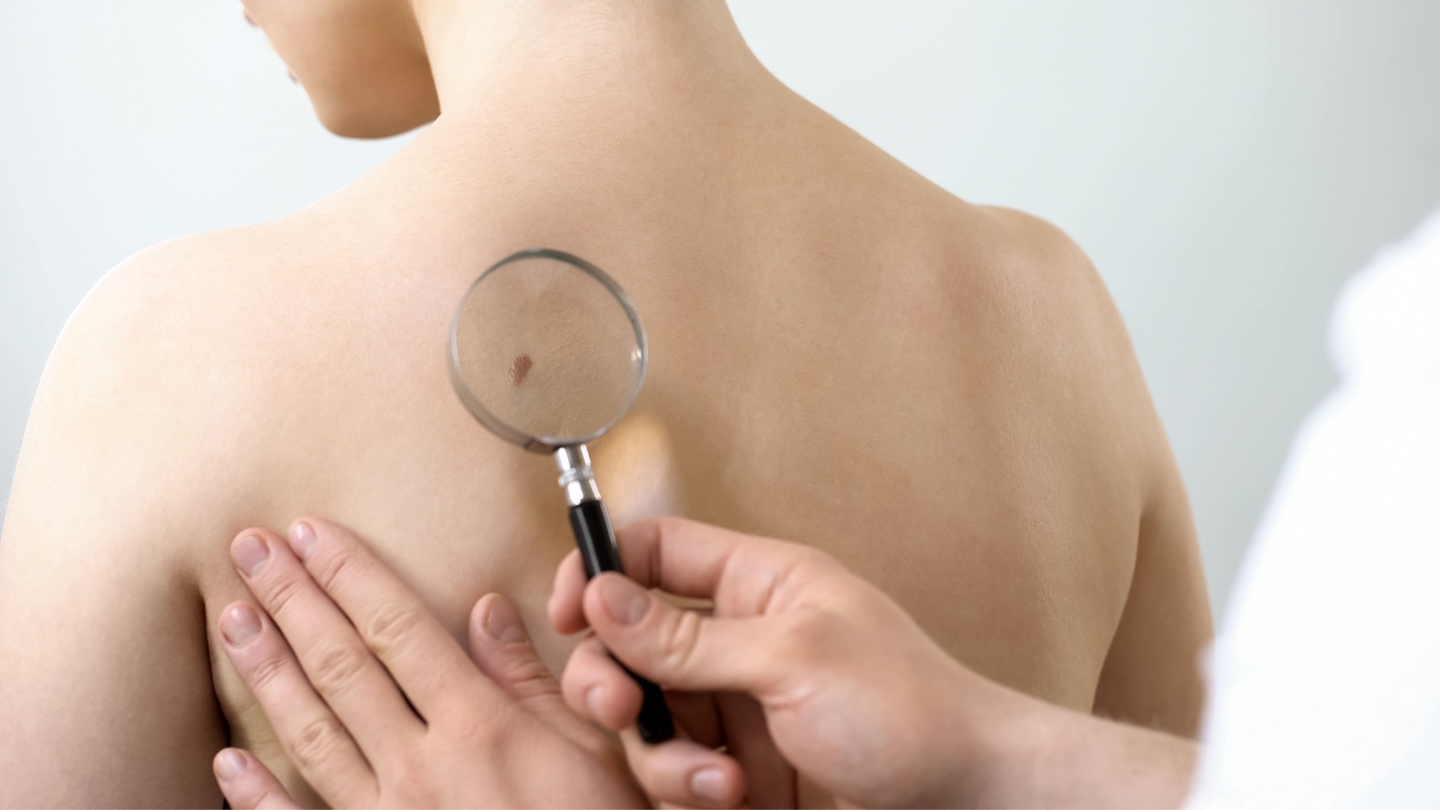 Câncer de pele é o tipo mais comum entre a população brasileira 