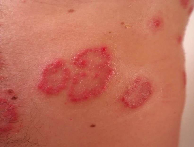 Dia Mundial da Psoríase: como a pandemia pode agravar o quadro