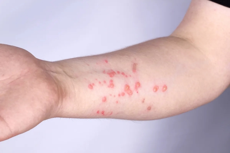 Suécia confirma primeiro caso de mpox