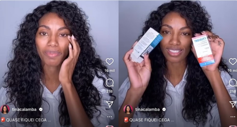 Ex-BBB Tina quase fica cega após usar pomada de cabelo