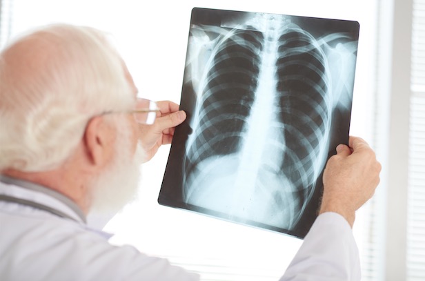 Especialistas alertam para sintomas da tuberculose durante pandemia