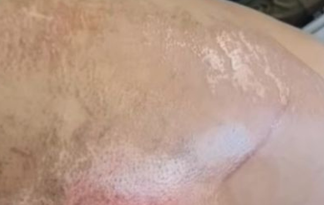 Ex inconformado atropela mulher no momento em que a vítima descia de moto