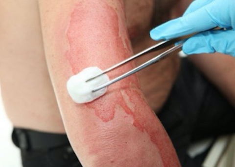 Fontes renováveis poderão ser usadas para queimaduras