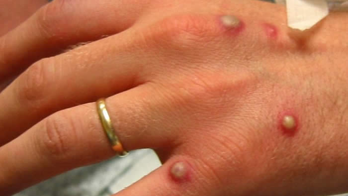 São Paulo confirma 2º caso de varíola dos macacos no Brasil