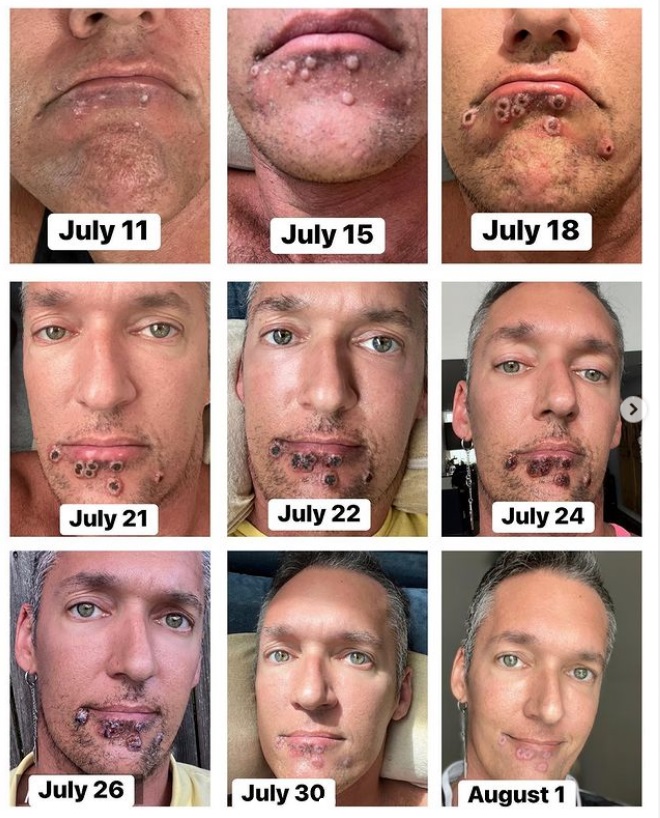  Ator pornô choca ao mostrar evolução da varíola dos macacos em seu rosto