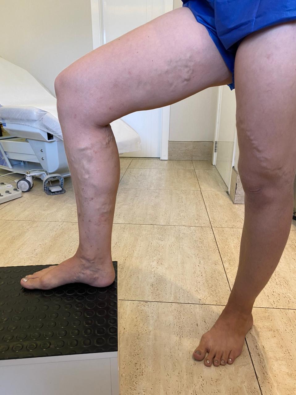 Varizes: Mitos e verdades sobre as inimigas das pernas