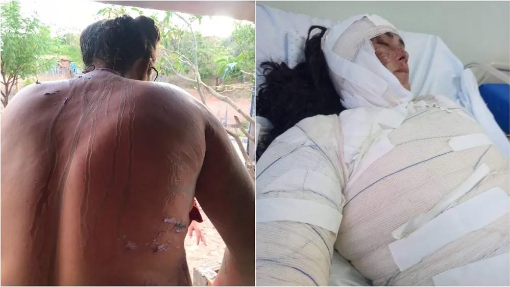Homem é preso por jogar ácido em corpo de mulher após briga com marido dela