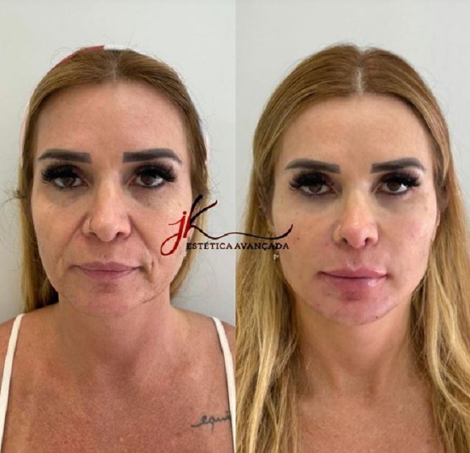 Mãe de Viih Tube faz harmonização e impressiona por semelhança com Virginia