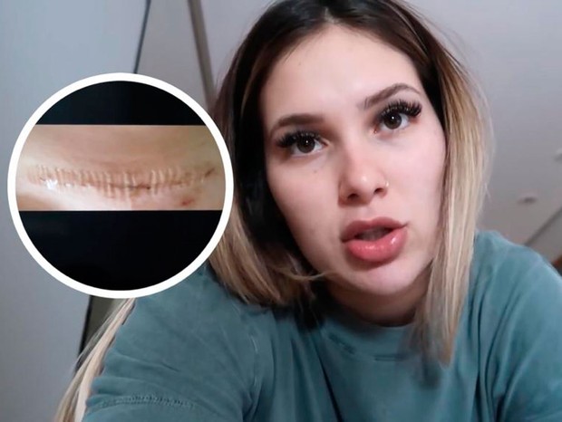 Virginia Fonseca mostra cicatriz da cesárea 18 dias após o parto