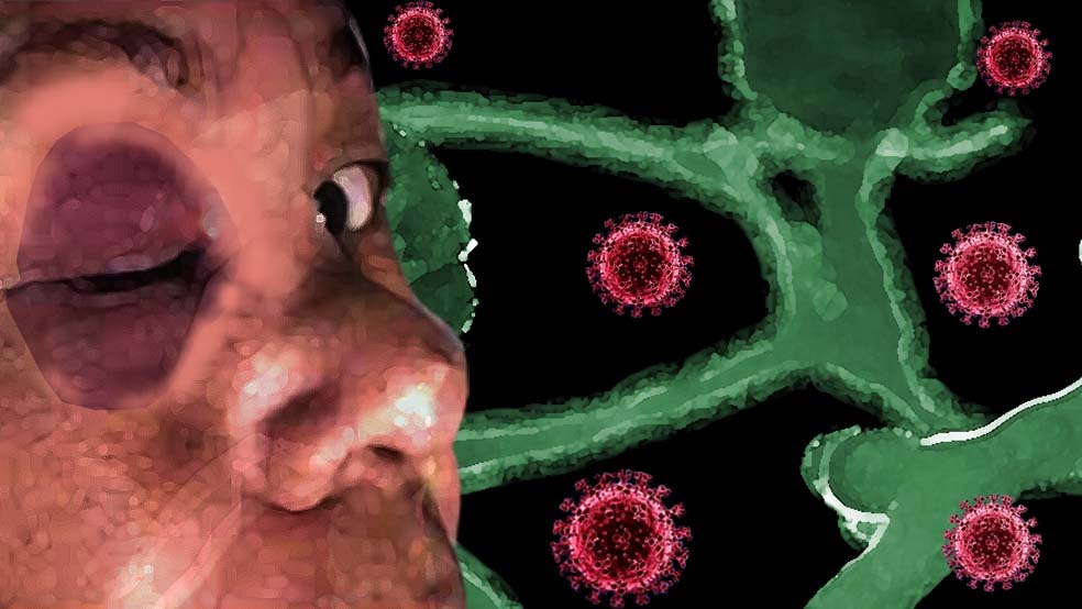 Saiba o que é ‘fungo preto’ que mutila e mata pacientes de covid na Índia